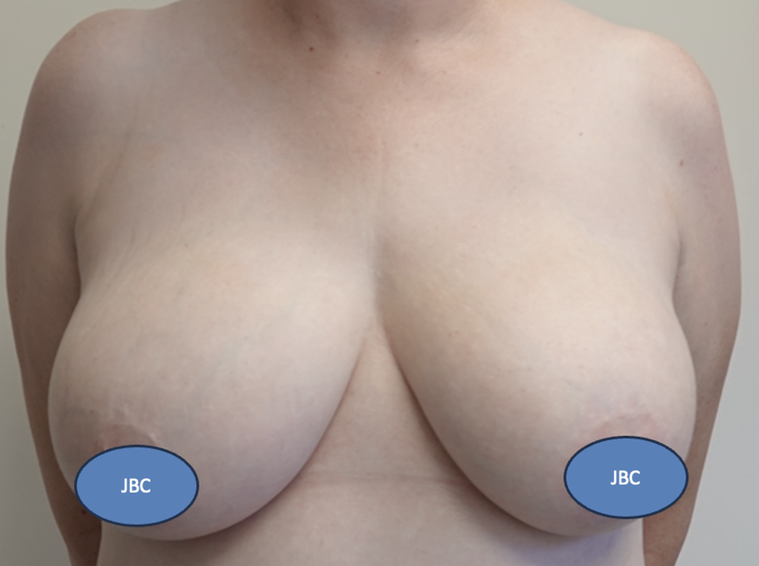 Breast Reduction Before Breast Reduction Before