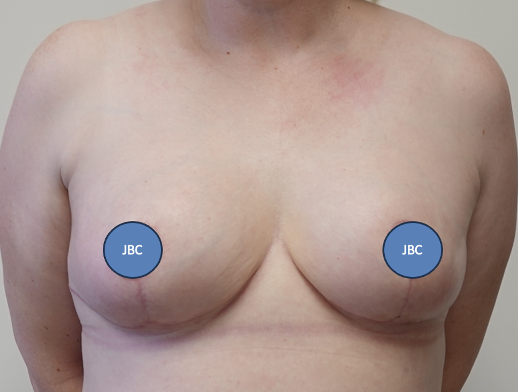 Breast Reduction After Breast Reduction After
