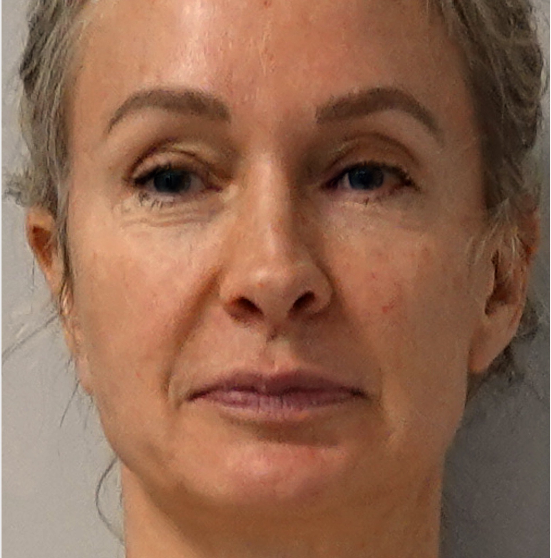 Blepharoplasty Before
