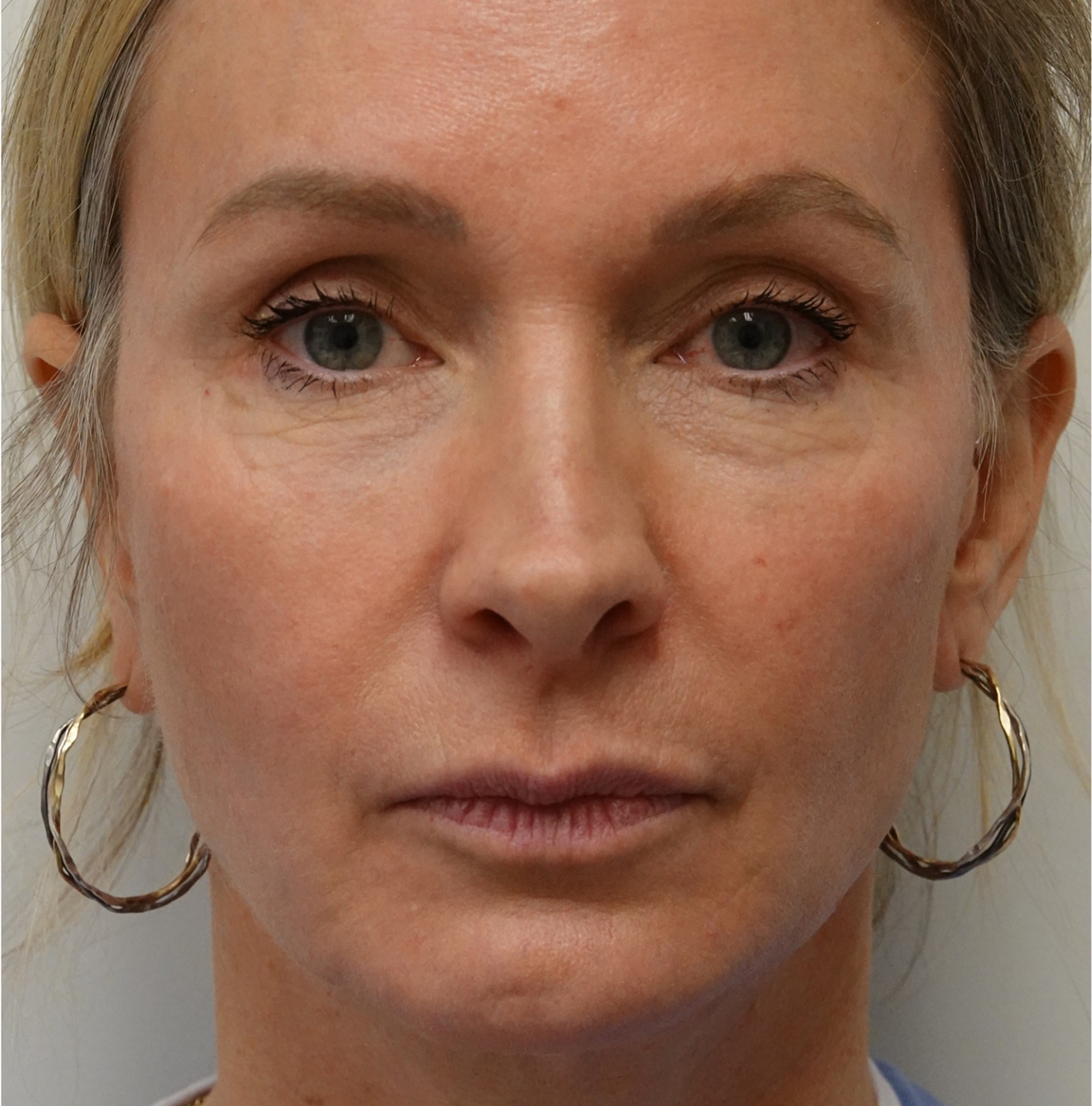 Blepharoplasty After