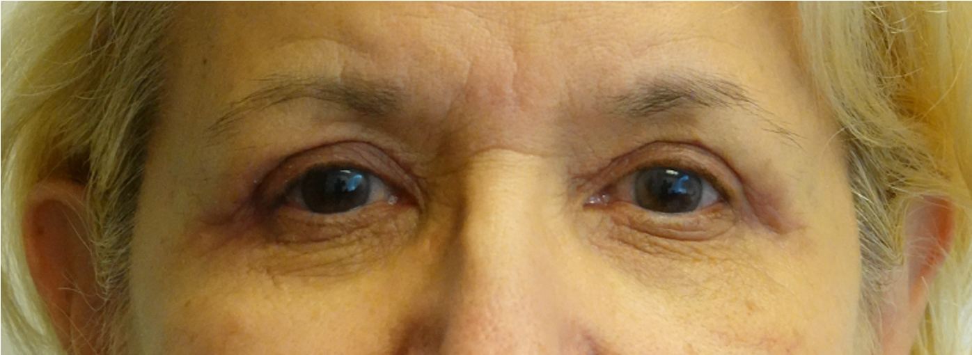 Blepharoplasty After Blepharoplasty After