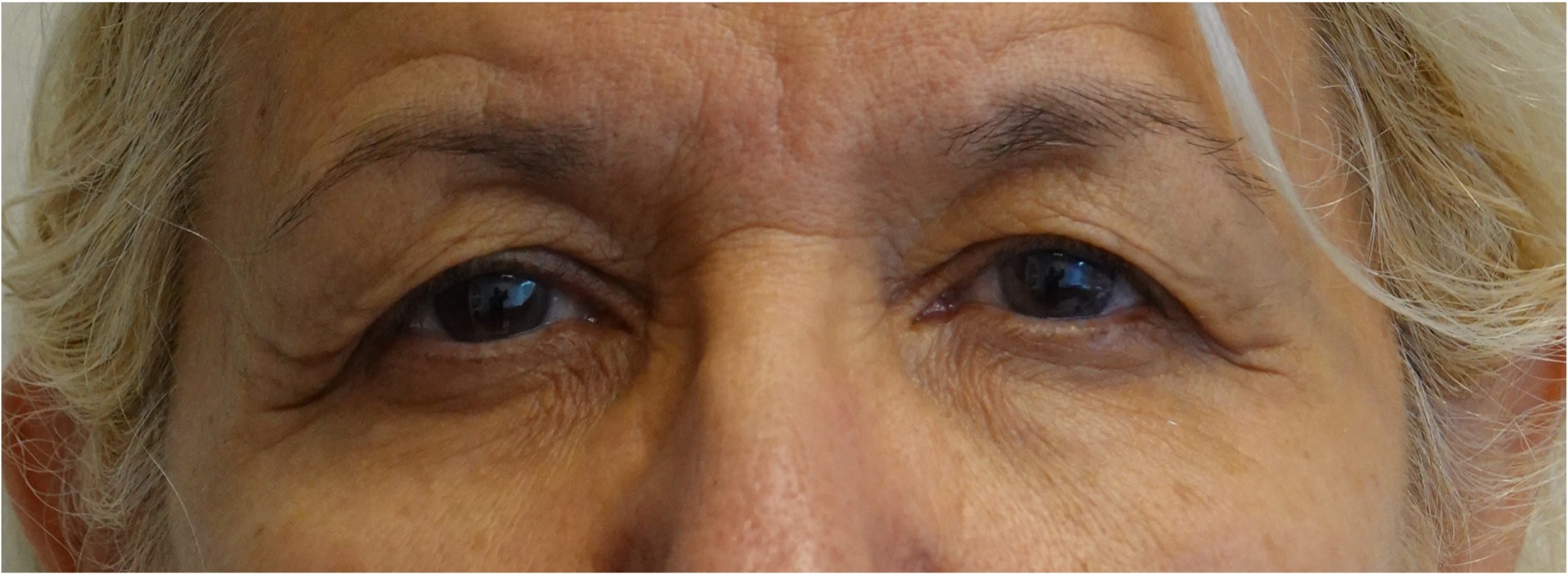 Blepharoplasty Before Blepharoplasty Before