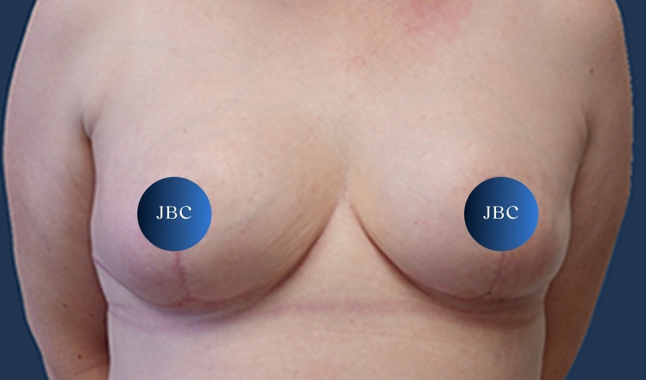 Breast Reduction After