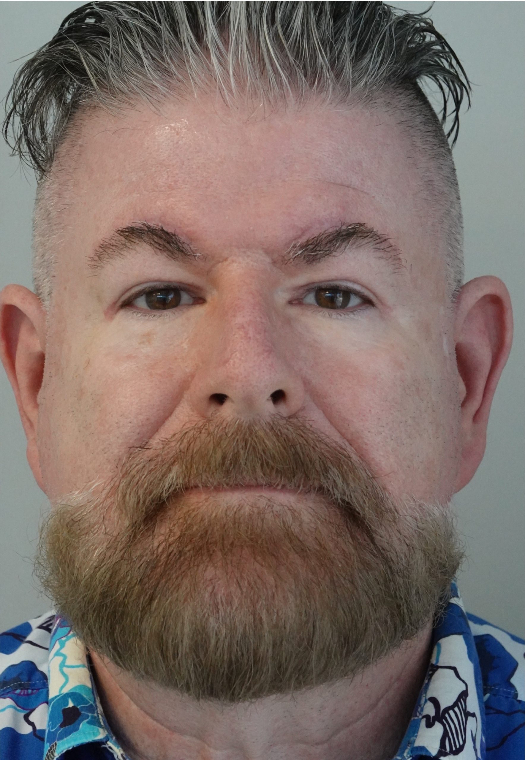 Blepharoplasty/Browlift After Blepharoplasty/Browlift After