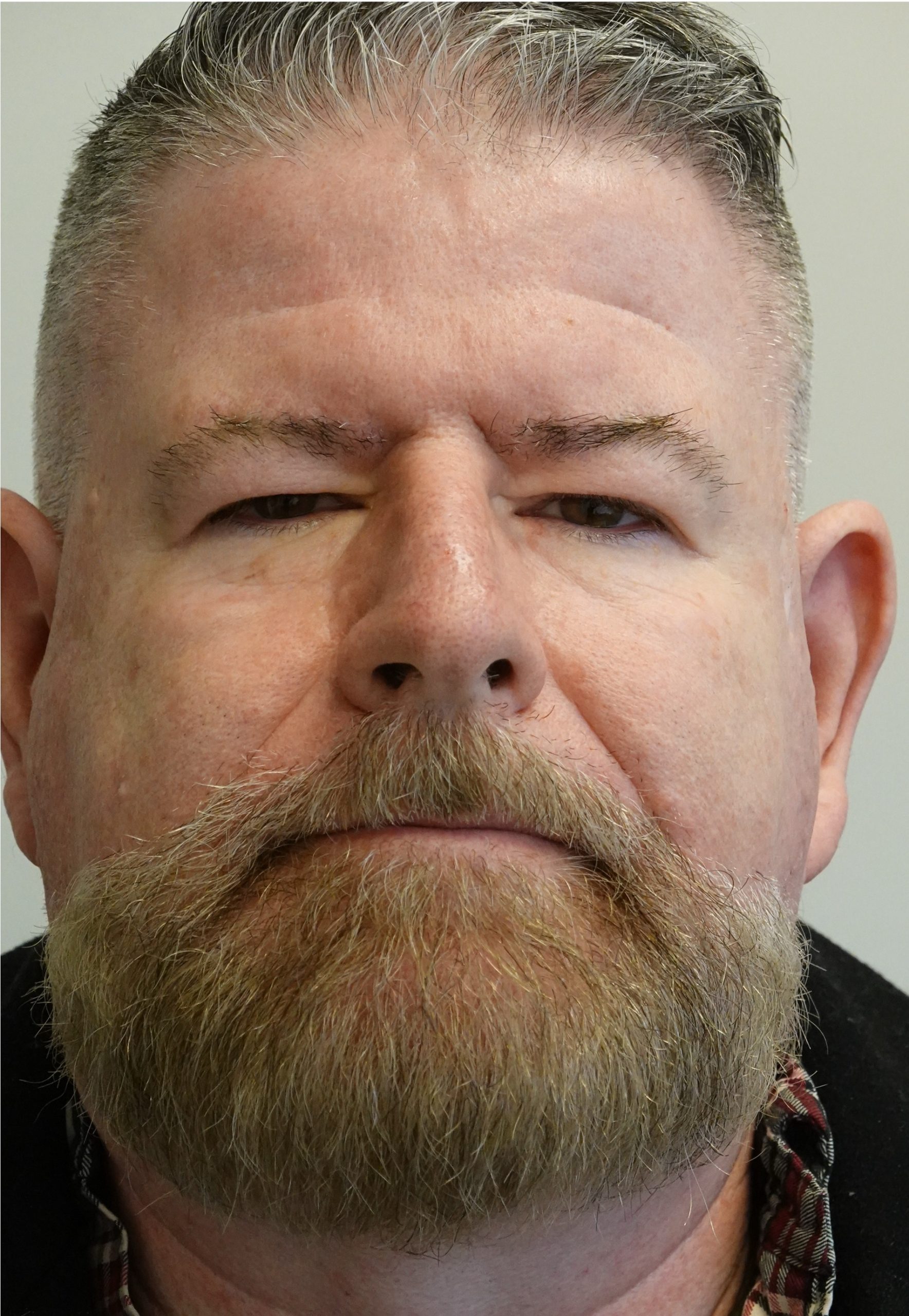 Blepharoplasty/Browlift Before Blepharoplasty/Browlift Before