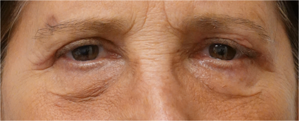 Blepharoplasty After Blepharoplasty After