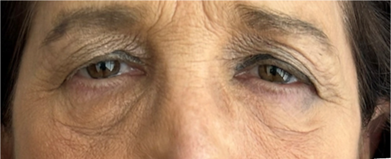 Blepharoplasty Before Blepharoplasty Before