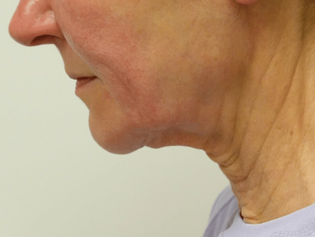 Facelift patient before