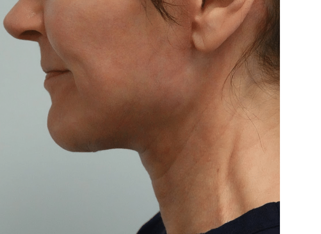 Facelift patient after