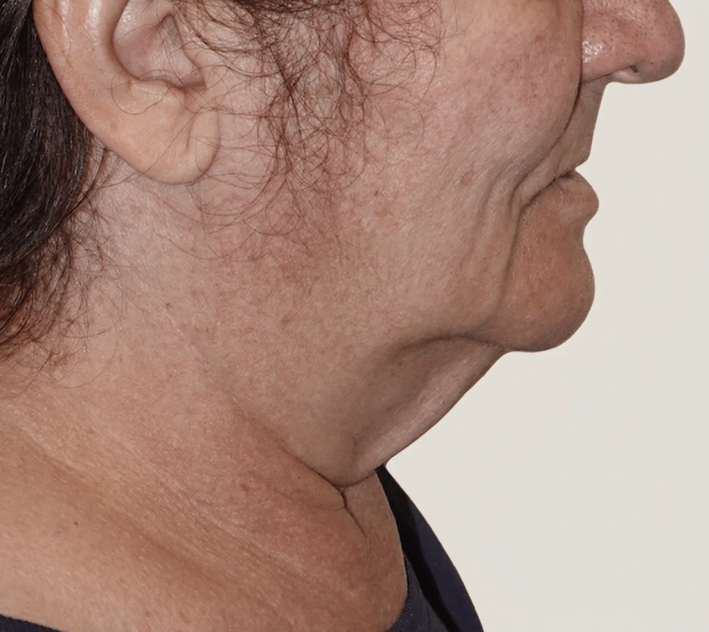 Facelift patient before