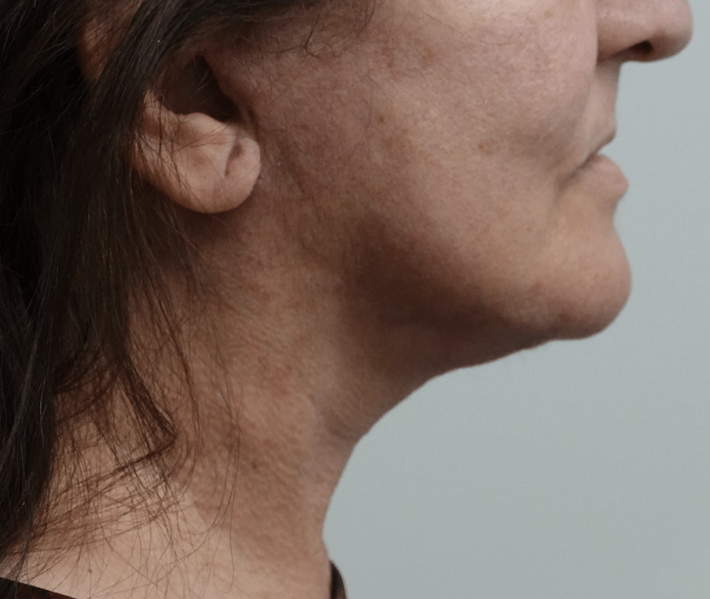 Facelift patient after